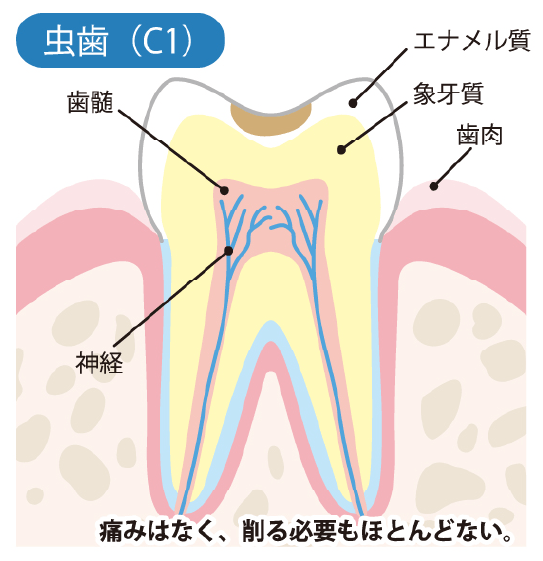 エナメル質内部の虫歯